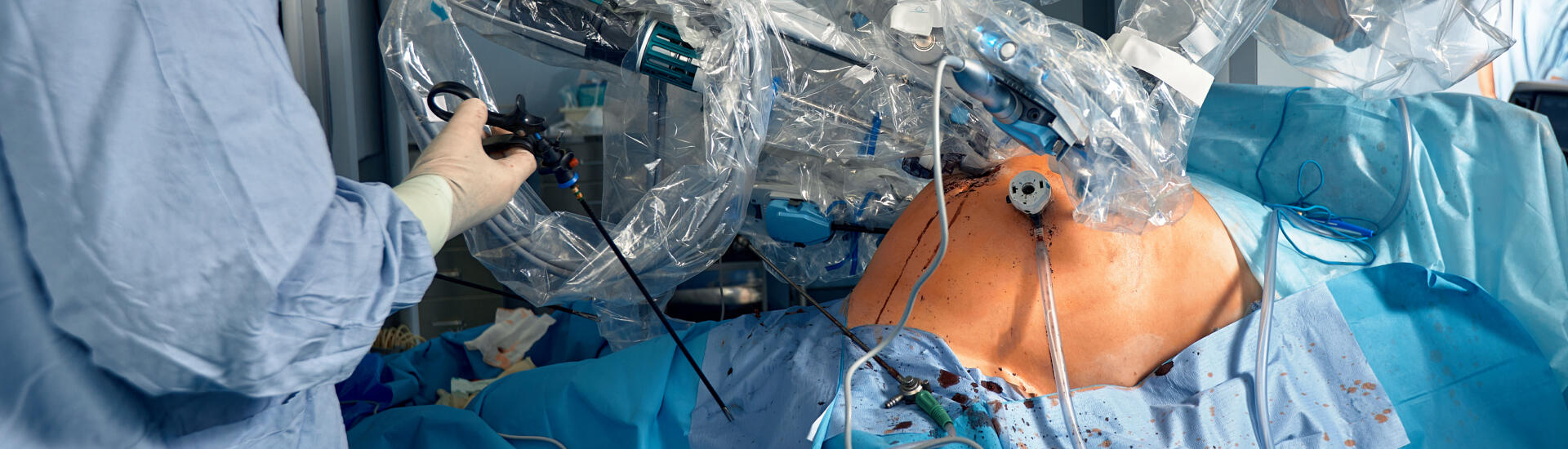A close-up view of an ongoing Robotic Assisted Nephrectomy procedure.