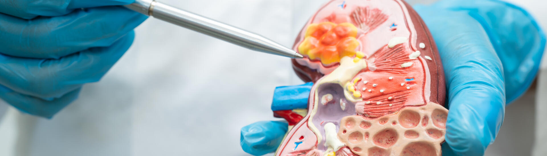An urologist points to a kidney model showing the calculi formation.